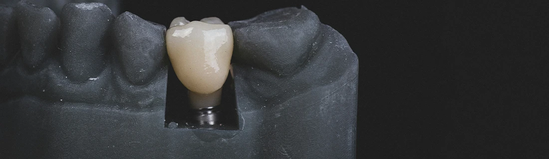 FC – Dental Implants at Canton Dental Group in Canton MA